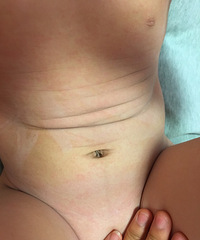 宝宝连续两晚高烧39.5 手脚腹股沟都是红疹 超痒!