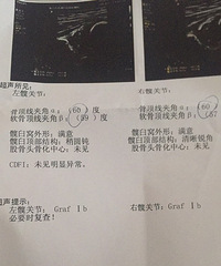 "宝宝腿纹不对称,B超做出来也不好"