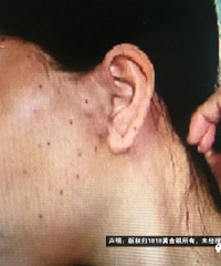 "想要一张温和笑脸,月嫂花了7万多做了“线雕”!现在却笑不出来