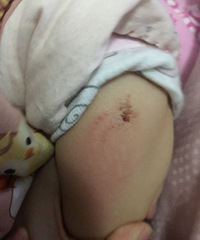 �����Ҽұ���������ʱ������ץ�ֱ� һץ�ͳ�Ѫ