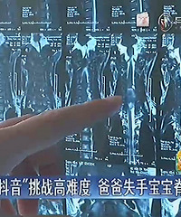 "学“抖音”挑战高难度,爸爸失手,2岁宝宝脊髓严重受损"