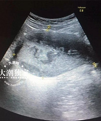 �������ݣ�����19����Ů����ͻ�ֳ�ζ ԭ�򾹸���ŮĤ�й�