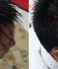 �ڳ��б����ͷ��Ѫ�� ��ȥ����ҽԺ