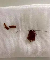 毛骨悚然!睡梦中嘉兴一姑娘耳朵里竟钻进6厘米长的...