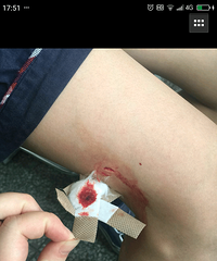 儿子在校被同学剪刀戳伤 皮都翻出来了