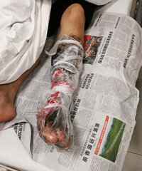 整条小腿被包住!嘉兴一男子深夜在工地被蛇咬 痛的不行···
