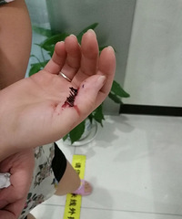 疼疼疼!凌晨一女工被九袜针倒钩插入手指