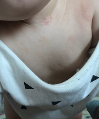娃身上的湿疹越长越多了 需要上激素药膏吗