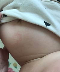 娃身上的湿疹越长越多了 需要上激素药膏吗