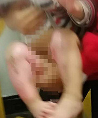 看看也疼!一岁半女孩双腿被烫得皮开肉绽