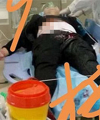 Ѫ�ȣ�2���Ӷ�Źһ�˱�ͱ��ICU