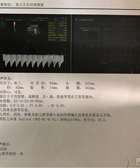 孕39周产检胎儿偏大一周 还能顺产吗