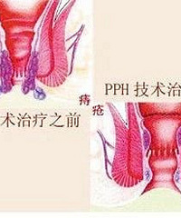 浙江IT小伙便血一个月还天天加班 结果晕倒在医院!