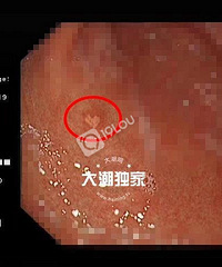 罕见!海宁60岁大伯去做胃镜!竟发现一颗“心”…