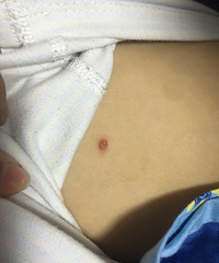 求教 娃腋下长了个肉疙瘩 还有个小洞洞要怎么处理