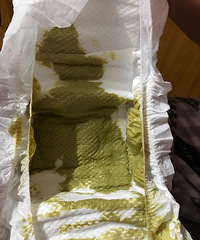 儿科,宝宝肺炎后大便这样