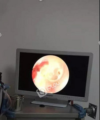 吓人!海宁一男子耳朵里竟长出蛆虫!这习惯几乎每个人都有!