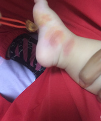 该死的蚊子 宝宝被咬成了“肉包” 又红又肿!