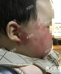 爸妈急哭!嘉兴3岁女孩脸上大片红疙瘩...竟和每天吃的这东西有关