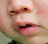 զ�죿���ӱ��Ĥ�� ��������Ѫ �к÷�����ƫ��֮�����