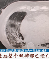 û���ղ����ԣ�һ��˫�ζ����ˣ���Ⱦ�¹ڻ��׷���