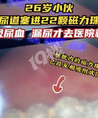 平湖26岁小伙尿道塞进22颗磁力珠!出现尿血、漏尿才去医院…