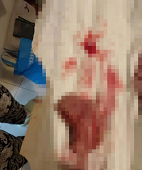 Ů��˳����Ժ���ų���Ѫɴ�� ������ҽ��ί�ѽ���