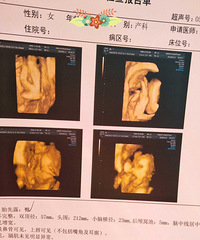 "宁波四维彩超归来~拍的很清楚,有吃手指可爱画面!"