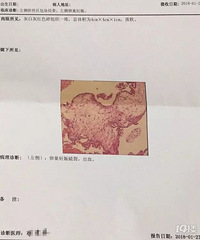 "宁波一女子遇罕见宫外孕,胎儿竟长在卵巢里!医院微创手术成功"