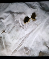 被爆竹炸伤4天后,衢州男子全身难以动弹,还差点咬断了舌头