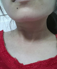 【红黄蓝孕妈日记】之头颈出现了几圈黑黑的