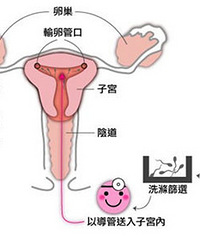 "人工受精和试管婴儿的区别是什么"