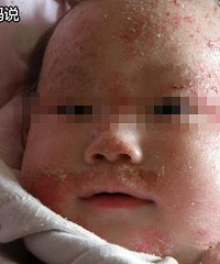 ƫ����ʪ����˰���ͼ��