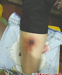 ���ӱ�����ҧһ���ȷ��ˣ�ҽԺ�²�Σ��