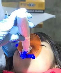 "和蛀牙说再见!临海免费窝沟封闭进校园,给孩子们的牙齿穿上铠甲