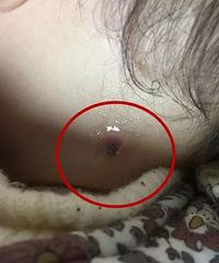 可怕!温岭一岁宝宝颈部钻进“吸血虫”,取虫不当可能致残