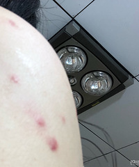 万能的19楼,被虫子咬成这样了,怎么办,痒的痛不欲生