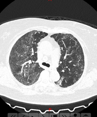 ��Ů�ӷβ�CT��ë����Ӱ��ֻ�������ڼ��������