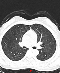 ��Ů�ӷβ�CT��ë����Ӱ��ֻ�������ڼ��������