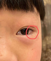 【带娃二三事】眼部过敏症高发季,磨人精的眼里长了水泡