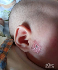 ����һ�Ⱥ���ʪ��������ȥҽԺ�������ҩ����Ч