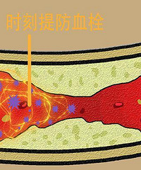 求助,脑梗塞是否过度治疗?挂针除血栓3天就能走路、自己吃饭…