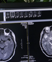 Ů�Ӱ��ɷ�ɱ����ʧȥ��ʶ����Щɥ����ҽ�����ⲡ�����ʸߴ�40