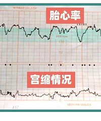 ��ͼʾ����̥�ļ໤����Ѫ����ⱨ�浥���ְ��ֽ�����ٶ���