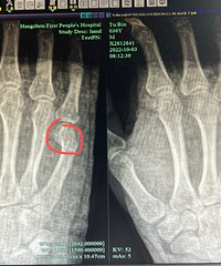 ���費�ڣ����ݰְ��ѵø�������д��ҵ����һȭͷ���Լ����ҽԺ