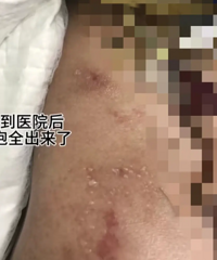 ���ǵϡ�©�硱�¼�Խ��Խ��ҽԺ���֤���ع⣬���ǵϽ�����Ӧ