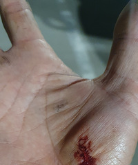 С�˿ڻ��ð����7�죬����һ�ܣ�ҽԺ�Ƿ������޲���������