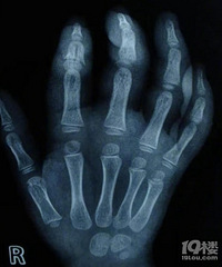 һ��ͯ��ָ���ھ��Ƕ������ѣ�ҽ��������סԺ