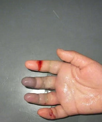 һ��ͯ��ָ���ھ��Ƕ������ѣ�ҽ��������סԺ