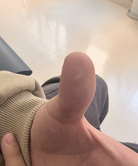 ����Һ���䶳���ƣ������Ժ���˵��ʹ���ȳ�Ѫ��